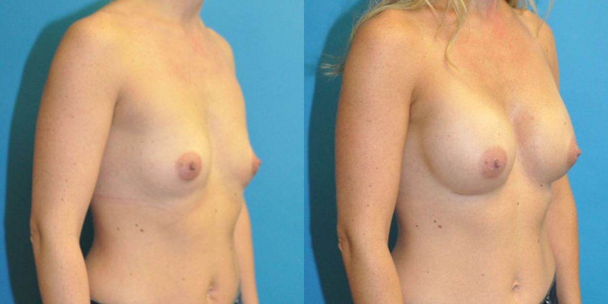 Breast Implant #104 - Before and After