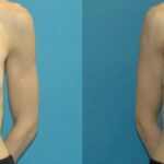 Breast Implant #105 - Before and After