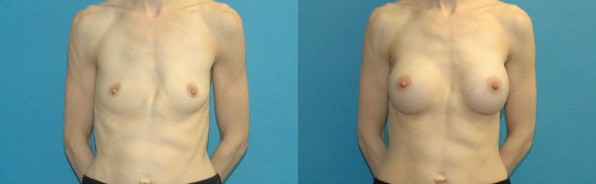 Breast Implant #105 - Before and After