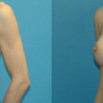 Breast Implant #105 - Before and After