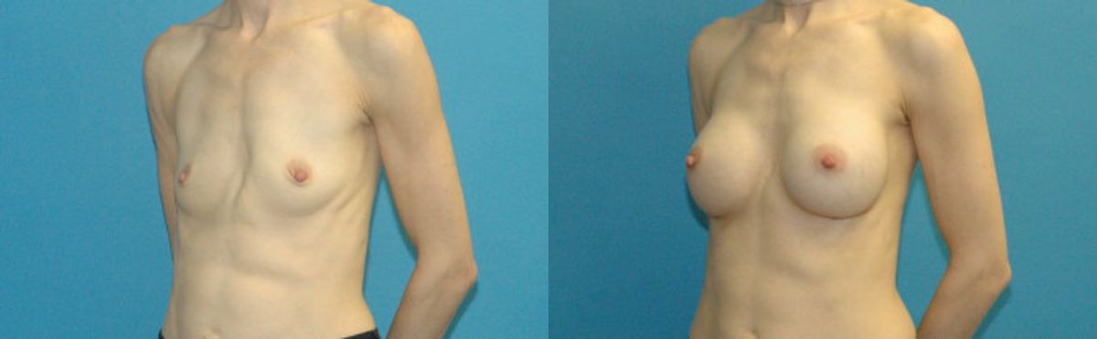 Breast Implant #105 - Before and After