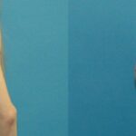 Breast Implant #105 - Before and After