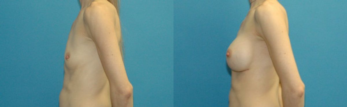 Breast Implant #105 - Before and After