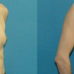 Breast Implant #105 - Before and After