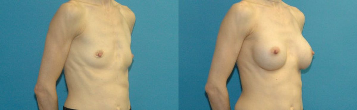 Breast Implant #105 - Before and After
