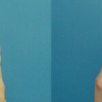 Breast Implant #105 - Before and After