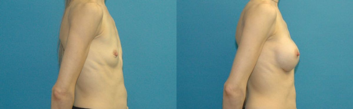 Breast Implant #105 - Before and After