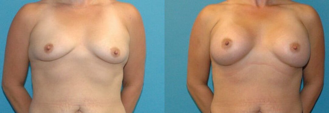 Breast Implant #106