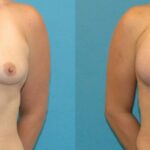 Breast Implant #106 - Before and After