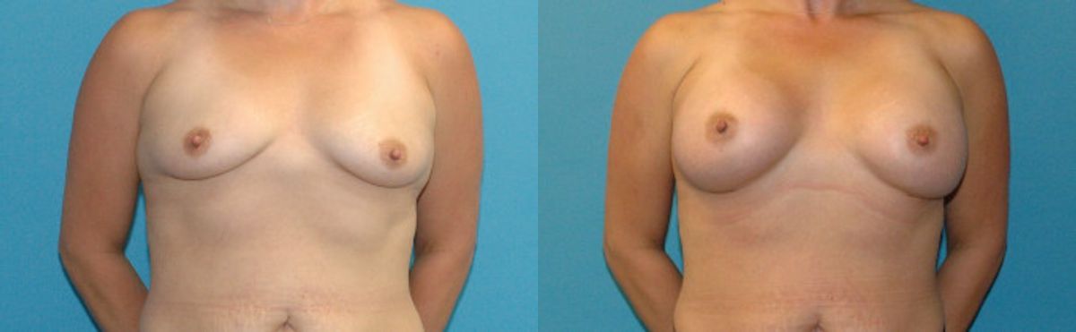 Breast Implant #106 - Before and After