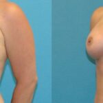 Breast Implant #106 - Before and After