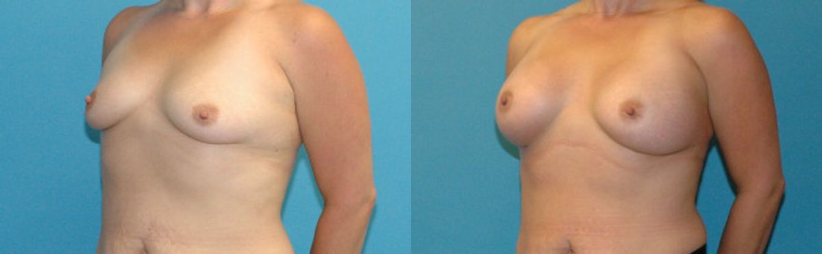 Breast Implant #106 - Before and After
