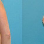 Breast Implant #106 - Before and After