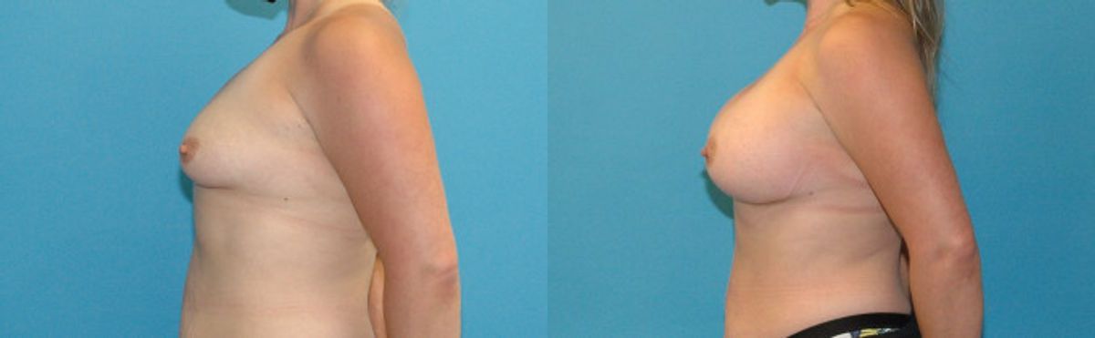 Breast Implant #106 - Before and After