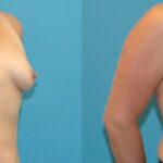 Breast Implant #106 - Before and After