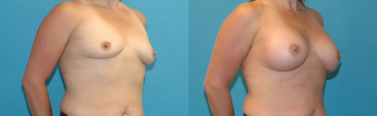 Breast Implant #106 - Before and After