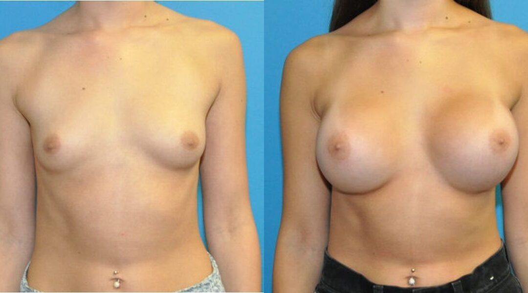 Breast Implant #107
