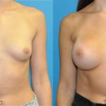 Breast Implant #107 - Before and After
