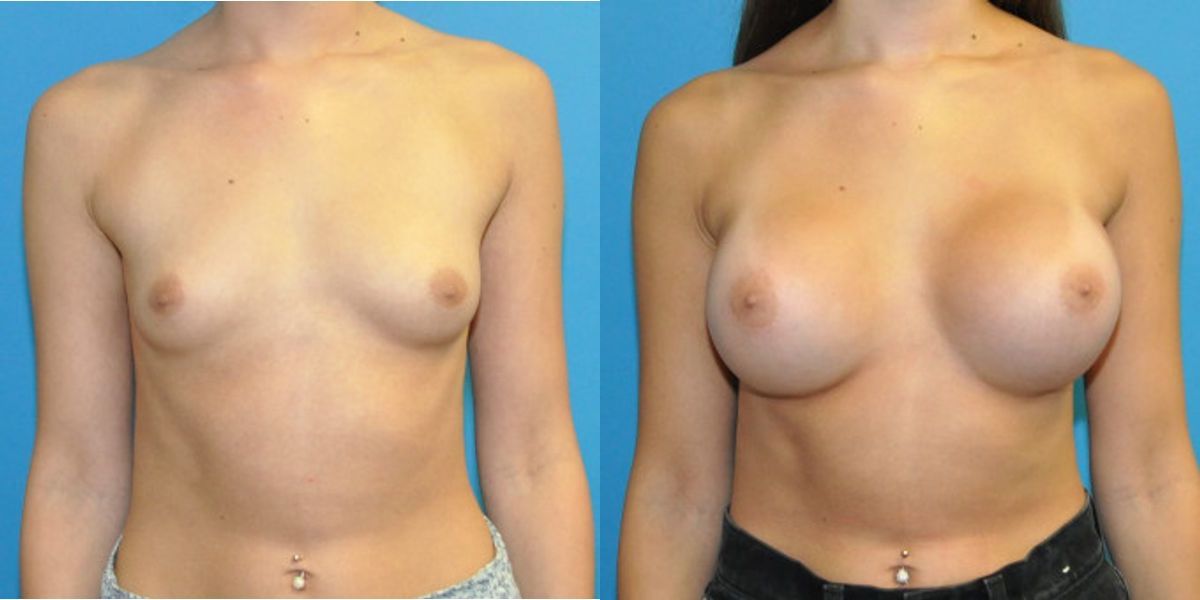 Breast Implant #107 - Before and After