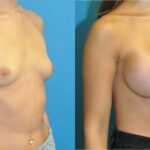 Breast Implant #107 - Before and After