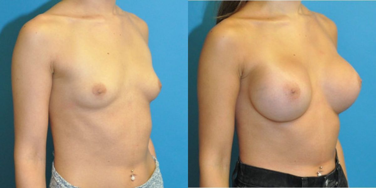 Breast Implant #107 - Before and After