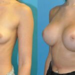 Breast Implant #107 - Before and After