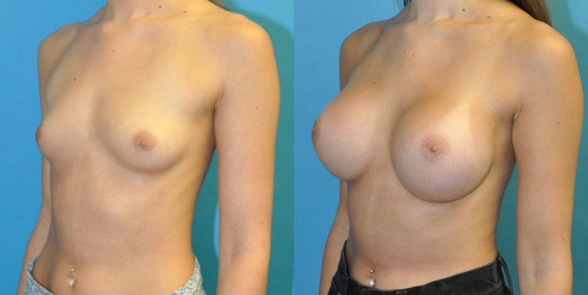 Breast Implant #107 - Before and After