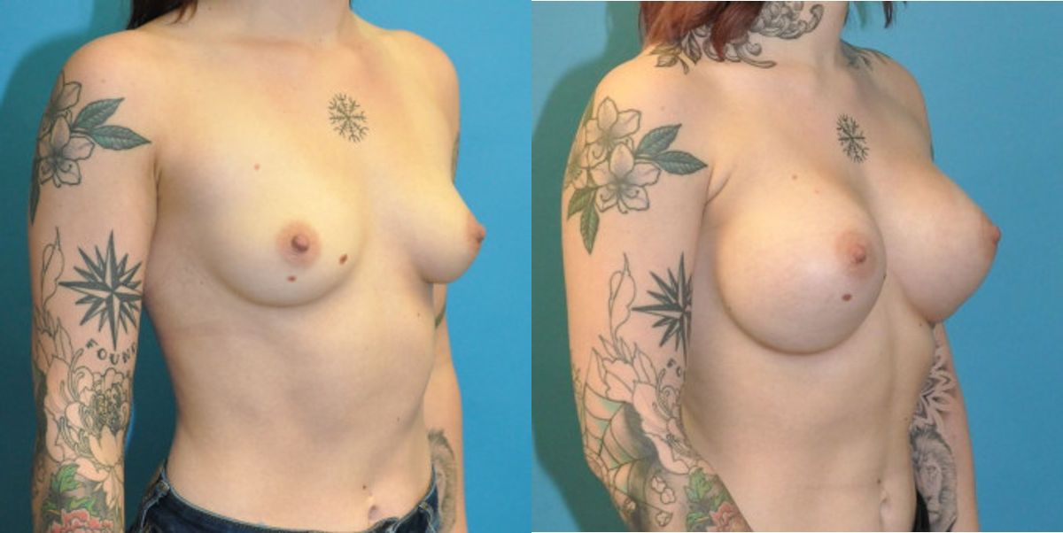 Breast Implant #108 - Before and After