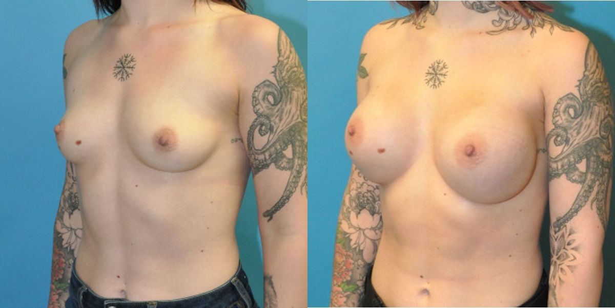 Breast Implant #108 - Before and After