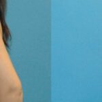 Breast Augmentation with Breast Implants #109 - Before and After