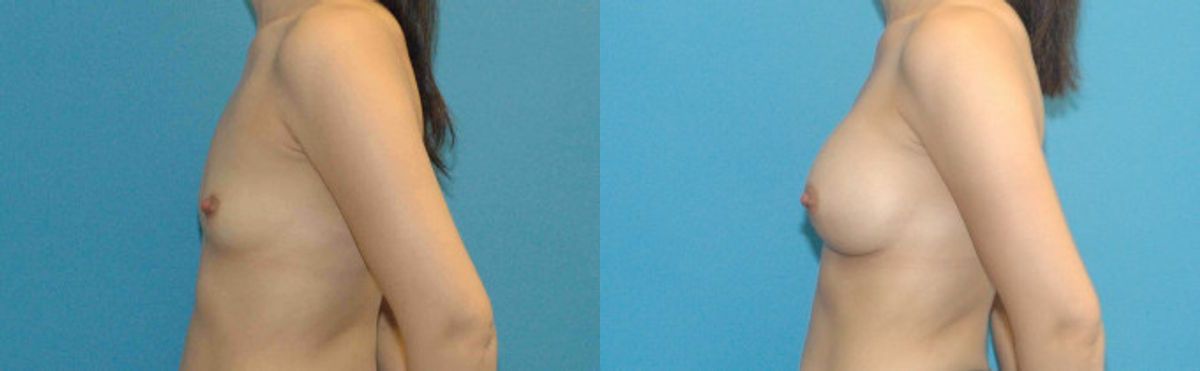 Breast Augmentation with Breast Implants #109 - Before and After