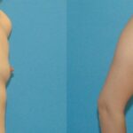 Breast Augmentation with Breast Implants #109 - Before and After