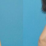 Breast Augmentation with Breast Implants #109 - Before and After