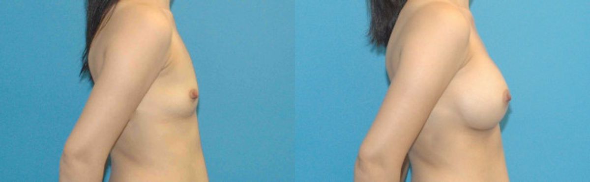 Breast Augmentation with Breast Implants #109 - Before and After