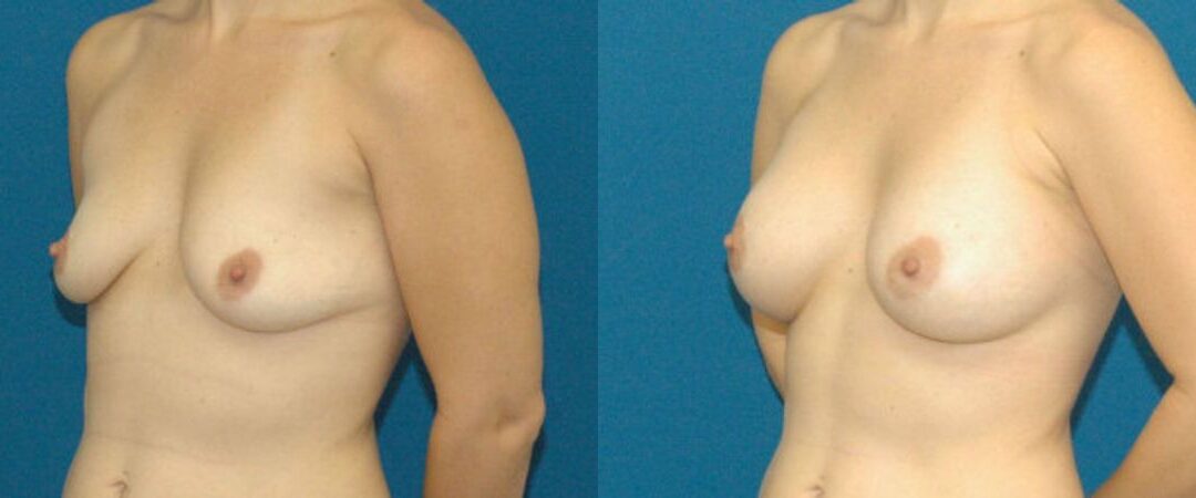 Breast Implant #11