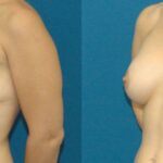 Breast Implant #11 - Before and After