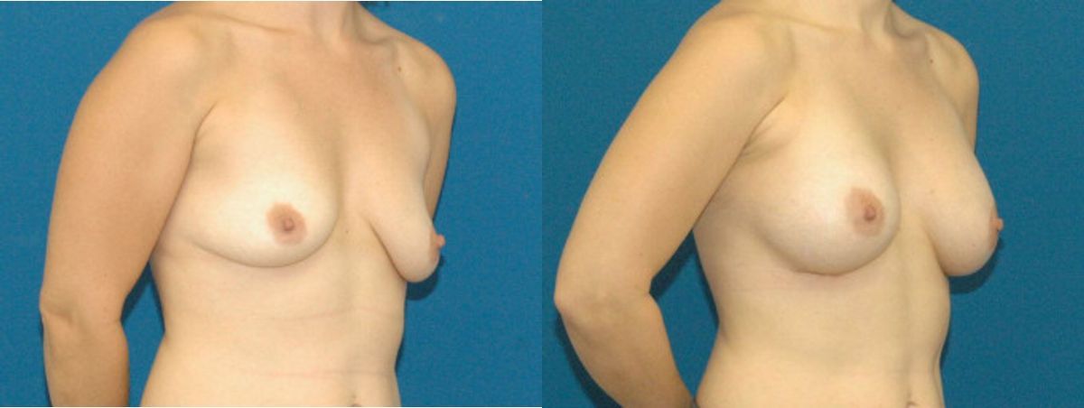 Breast Implant #11 - Before and After