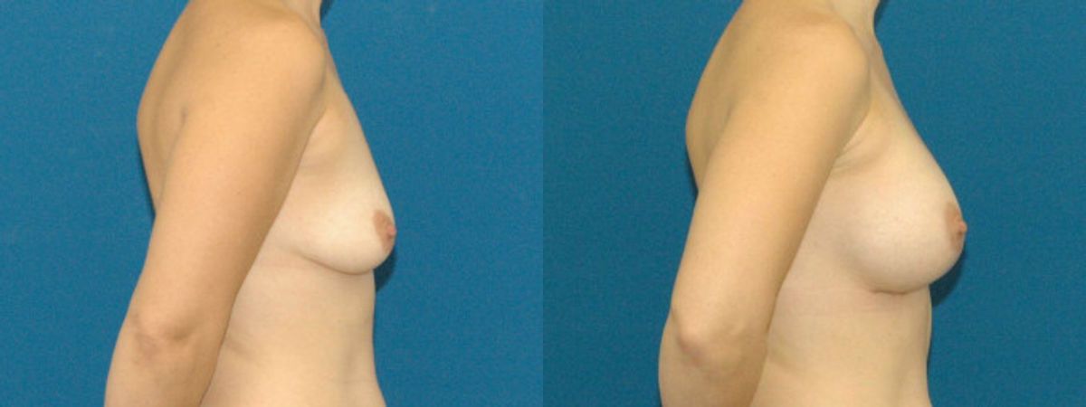 Breast Implant #11 - Before and After