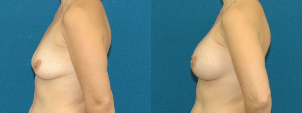 Breast Implant #11 - Before and After