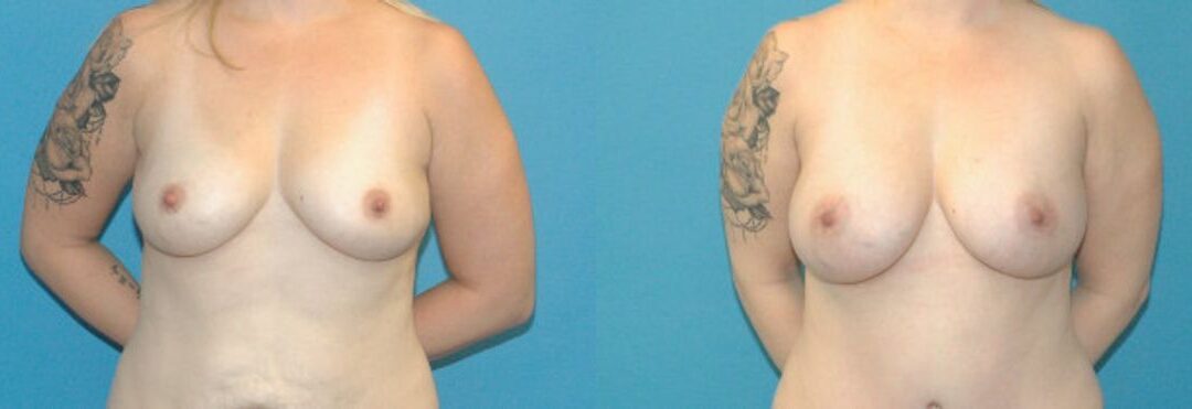 Breast Augmentation with Breast Implants #110