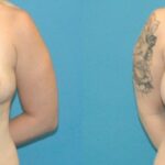 Breast Augmentation with Breast Implants #110 - Before and After