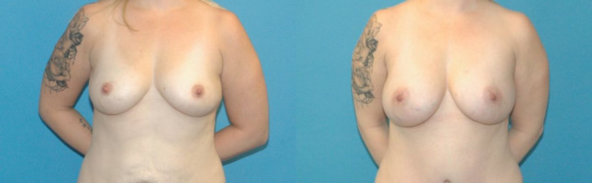 Breast Augmentation with Breast Implants #110 - Before and After