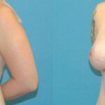 Breast Augmentation with Breast Implants #110 - Before and After