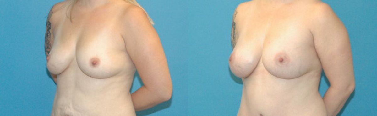 Breast Augmentation with Breast Implants #110 - Before and After
