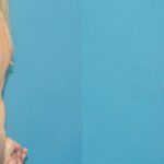 Breast Augmentation with Breast Implants #110 - Before and After