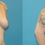 Breast Augmentation with Breast Implants #110 - Before and After