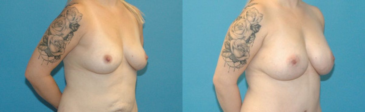 Breast Augmentation with Breast Implants #110 - Before and After