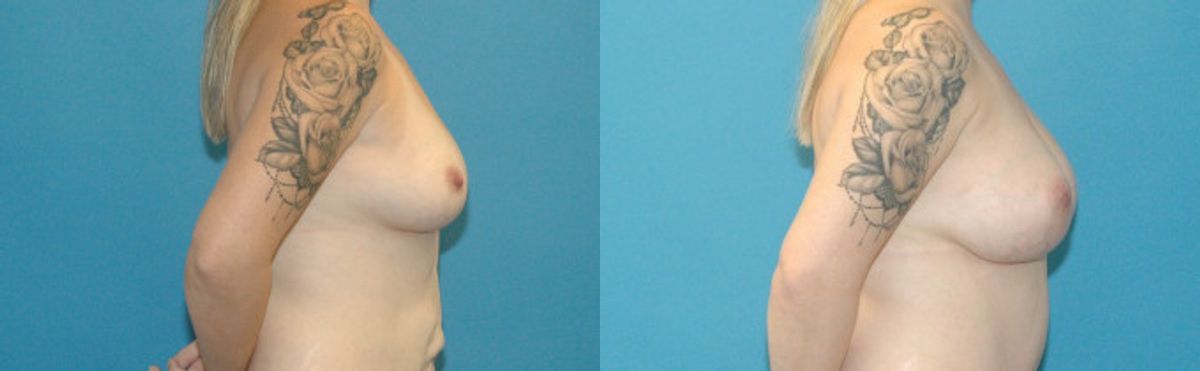 Breast Augmentation with Breast Implants #110 - Before and After