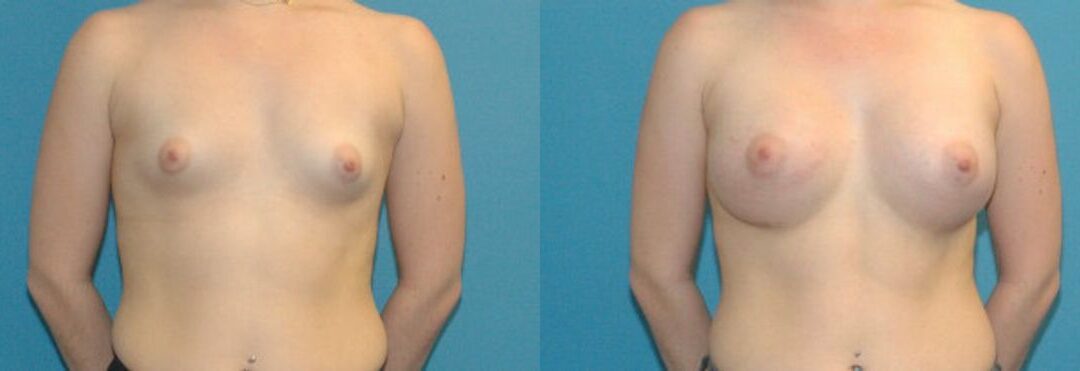 Breast Augmentation with Breast Implants #111
