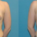 Breast Augmentation with Breast Implants #111 - Before and After